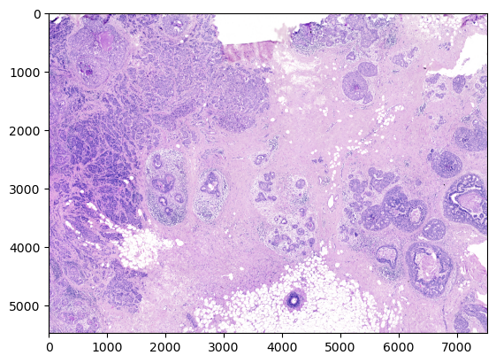../../_images/analysis_breast_cancer_breast_cancer_data_16_1.png